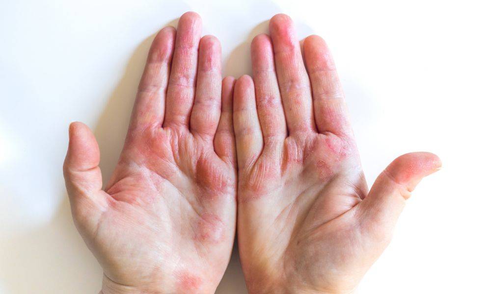 How to Treat Dyshidrotic Eczema on Your Hands?