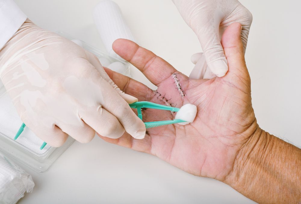 Trigger Finger Surgery: What You Need to Know
