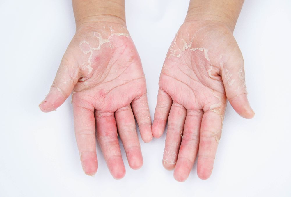 Dry Hands Get Soft in 3 Steps